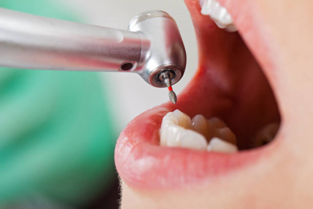 Best Knocked-Out Tooth (Avulsed Tooth) Treatment in Cisco, TX